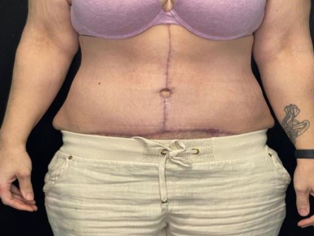 after tummy tuck front view female patient case 1677