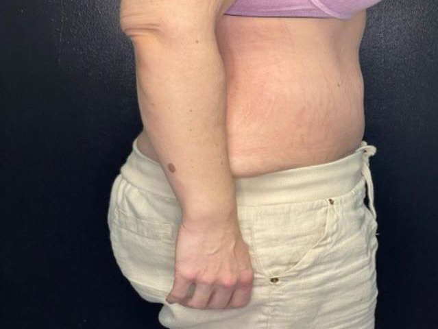 after tummy tuck right side view female patient case 1677