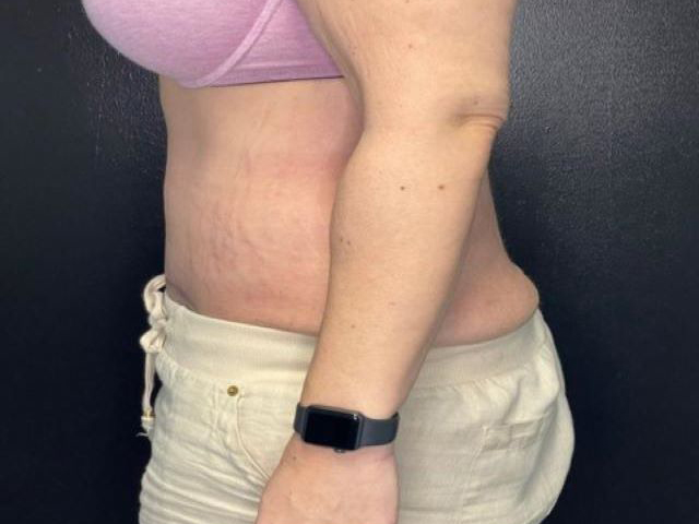 after tummy tuck left side view female patient case 1677