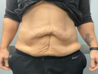before tummy tuck front view female patient case 1677