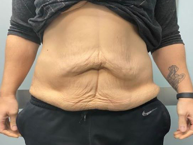 before tummy tuck front view female patient case 1677