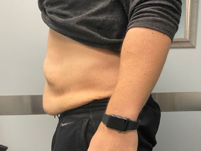 before tummy tuck left side view female patient case 1677