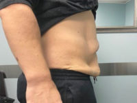 before tummy tuck right side view female patient case 1677