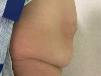 before tummy tuck right view female patient case 1684