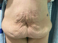 before tummy tuck front view female patient case 1684