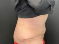 after tummy tuck right view female patient case 1684