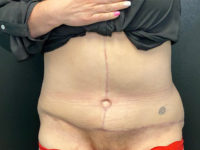 after tummy tuck front view female patient case 1684