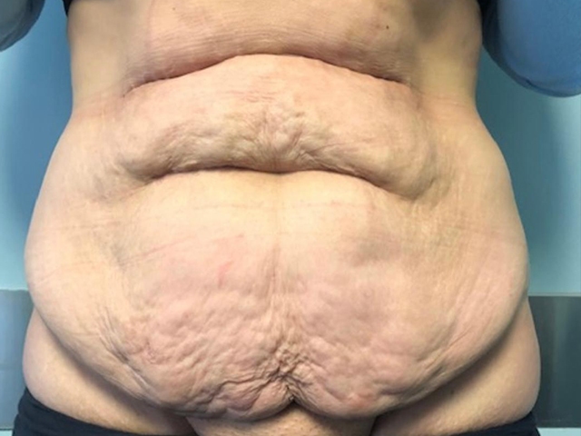 before tummy tuck front view female patient case 1962